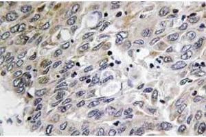 Immunohistochemistry (IHC) analyzes of C1q-C antibody in paraffin-embedded human lung carcinoma tissue. (C1QC 抗体)