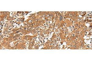 Immunohistochemistry of paraffin-embedded Human cervical cancer tissue using GFI1 Polyclonal Antibody at dilution of 1:100(x200) (GFI1 抗体)