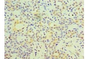 Immunohistochemistry of paraffin-embedded human breast cancer using ABIN7153128 at dilution of 1:100 (FOSL2 抗体  (AA 187-326))