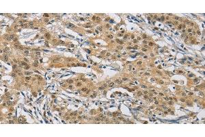 Immunohistochemistry of paraffin-embedded Human gastric cancer using NAPSA Polyclonal Antibody at dilution of 1:50 (NAPSA 抗体)