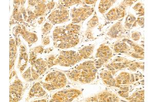 FUT6 Antibody at 1/100 staining Human liver cancer by IHC-P. (FUT6 抗体  (N-Term))