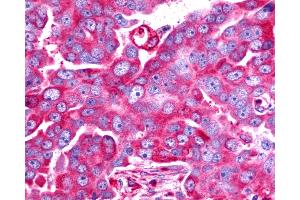Anti-TAAR6 antibody IHC of human Ovary, Carcinoma. (TAAR6 抗体  (C-Term))