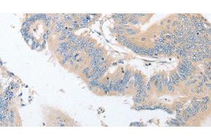 Immunohistochemistry of paraffin-embedded Human colon cancer using EPS15L1 Polyclonal Antibody at dilution of 1:30 (EPS15L1 抗体)
