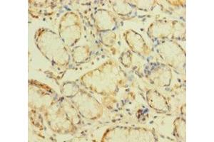Immunohistochemistry of paraffin-embedded human gastric cancer using ABIN7176189 at dilution of 1:100 (ZNF26 抗体  (AA 335-533))