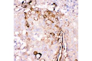 Anti- Gelsolin antibody, IHC(P) IHC(P): Human Mammary Cancer Tissue (Gelsolin 抗体  (AA 580-782))