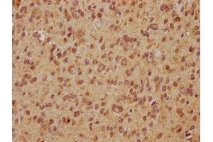 IHC image of ABIN7152257 diluted at 1:560 and staining in paraffin-embedded human glioma cancer performed on a Leica BondTM system. (EXOC7 抗体  (AA 521-735))