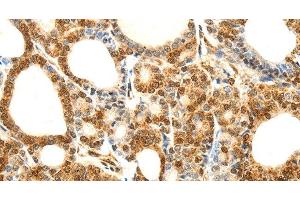 Immunohistochemistry of paraffin-embedded Human thyroid cancer using Otocadherin Polyclonal Antibody at dilution of 1:80 (CDH23 抗体)