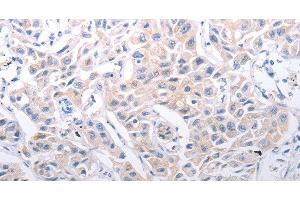 Immunohistochemistry of paraffin-embedded Human lung cancer using SLC39A6 Polyclonal Antibody at dilution of 1:30 (SLC39A6 抗体)