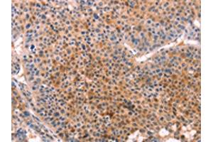 The image on the left is immunohistochemistry of paraffin-embedded Human liver cancer tissue using ABIN7129127(CYP1B1 Antibody) at dilution 1/20, on the right is treated with fusion protein. (CYP1B1 抗体)