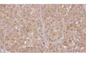 ABIN6277480 at 1/100 staining Human Melanoma tissue by IHC-P. (Neurotrophin 3 抗体  (Internal Region))