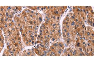 Immunohistochemistry of paraffin-embedded Human liver cancer tissue using Ephrin A5 Polyclonal Antibody at dilution 1:40 (Ephrin A5 抗体)