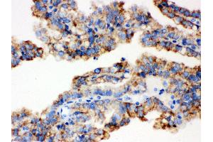 Anti- ALDH2 Picoband antibody, IHC(P) IHC(P): Human Kidney Cancer Tissue (ALDH2 抗体  (N-Term))