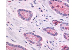 Anti-GPR87 antibody IHC of human Prostate, Carcinoma. (GPR87 抗体  (N-Term))