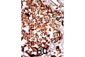 Formalin-fixed and paraffin-embedded human cancer tissue reacted with the primary antibody, which was peroxidase-conjugated to the secondary antibody, followed by DAB staining. (NRBP1 抗体  (N-Term))