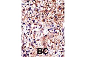 Formalin-fixed and paraffin-embedded human cancer tissue reacted with CAPRIN1 polyclonal antibody  , which was peroxidase-conjugated to the secondary antibody, followed by DAB staining . (Caprin-1 抗体  (AA 625-654))