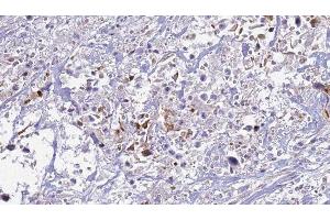 ABIN6277521 at 1/100 staining Human urothelial cancer tissue by IHC-P. (S100A12 抗体)