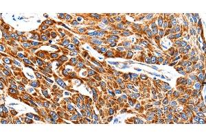 Immunohistochemistry of paraffin-embedded Human esophagus cancer using HSP75 Polyclonal Antibody at dilution of 1:100 (TRAP1 抗体)