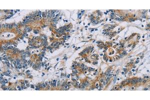 Immunohistochemistry of paraffin-embedded Human colon cancer using CSNK1E Polyclonal Antibody at dilution of 1:60 (CK1 epsilon 抗体)