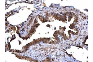 IHC-P Image CD74 antibody [N1N2], N-term detects CD74 protein at cytoplasm on human lung carcinoma by immunohistochemical analysis. (CD74 抗体  (N-Term))