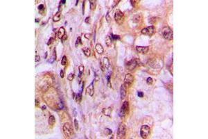 Immunohistochemical analysis of MAF1 staining in human breast cancer formalin fixed paraffin embedded tissue section. (MAF1 抗体  (Center))
