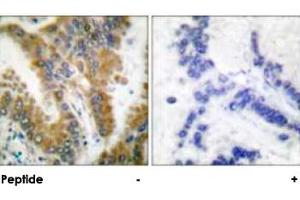 Immunohistochemical analysis of paraffin-embedded human lung carcinoma tissue, using CRKL polyclonal antibody . (CrkL 抗体)