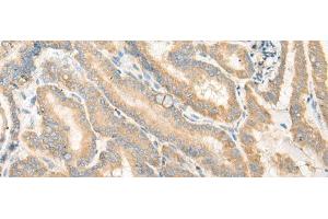Immunohistochemistry of paraffin-embedded Human thyroid cancer tissue using EPB41L4B Polyclonal Antibody at dilution of 1:35(x200) (EPB41L4B 抗体)