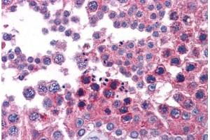 Immunohistochemistry (Formalin-fixed Paraffin-embedded Sections) (IHC (fp)) image for anti-Signal Transducer and Activator of Transcription 6, Interleukin-4 Induced (STAT6) (AA 614-663) antibody (ABIN6745701)