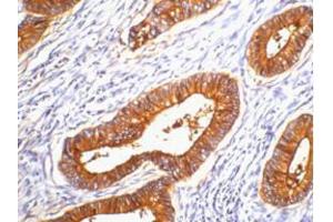 Immunohistochemistry (IHC) image for anti-Carcinoembryonic Antigen Gene Family (CEA) antibody (ABIN3178614) (CEA 抗体)