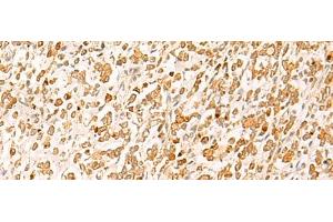 Immunohistochemistry of paraffin-embedded Human gastric cancer tissue using HTT Polyclonal Antibody at dilution of 1:25(x200) (Huntingtin 抗体)