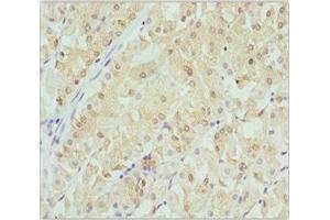 Immunohistochemistry of paraffin-embedded human gastric cancer using ABIN7145471 at dilution of 1:100 (CRYGS 抗体  (AA 1-178))