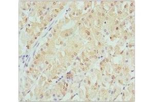 Immunohistochemistry of paraffin-embedded human gastric cancer using ABIN7145471 at dilution of 1:100 (CRYGS 抗体  (AA 1-178))