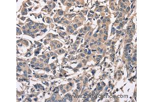 Immunohistochemistry of Human breast cancer using PEBP1 Polyclonal Antibody at dilution of 1:50 (PEBP1 抗体)