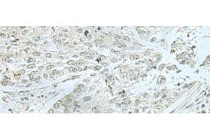 Immunohistochemistry of paraffin-embedded Human lung cancer tissue using THTPA Polyclonal Antibody at dilution of 1:70(x200) (THTPA 抗体)