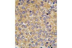 Formalin-fixed and paraffin-embedded human prostata carcinoma tissue reacted with PLAU antibody (N-term), which was peroxidase-conjugated to the secondary antibody, followed by DAB staining. (PLAU 抗体  (N-Term))
