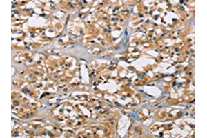 The image on the left is immunohistochemistry of paraffin-embedded Human thyroid cancer tissue using ABIN7130690(PPP3CA Antibody) at dilution 1/30, on the right is treated with fusion protein. (PPP3CA 抗体)