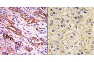 (LEFT)Formalin-fixed and paraffin-embedded human cancer tissue reacted with the primary antibody, which was peroxidase-conjugated to the secondary antibody, followed by DAB staining. (GRK1 抗体  (C-Term))