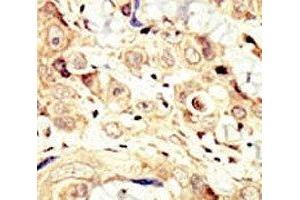 IHC analysis of FFPE human breast carcinoma tissue stained with the HER4 antibody (ERBB4 抗体  (AA 25-55))