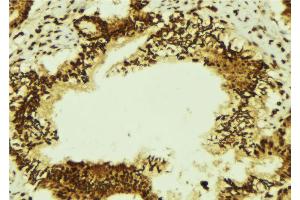 ABIN6274346 at 1/100 staining Human breast cancer tissue by IHC-P. (TRA2A 抗体  (C-Term))