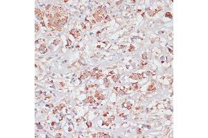 Immunohistochemistry of paraffin-embedded Human breast cancer using Desmoplakin antibody (ABIN6134106, ABIN6139838, ABIN6139840 and ABIN6223548) at dilution of 1:100 (40x lens). (Desmoplakin 抗体  (AA 1-100))