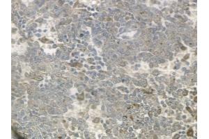 ABIN6259318 and ABIN6274720 at 1/100 staining human melanoma by IHC-P. (MRPS18C 抗体  (Internal Region))