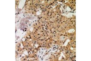 Immunohistochemical analysis of MNK1 (pT250) staining in human breast cancer formalin fixed paraffin embedded tissue section. (MKNK1 抗体  (pSer250))