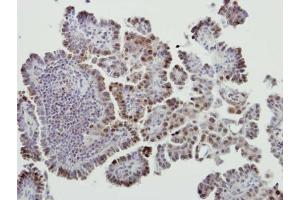IHC-P Image Immunohistochemical analysis of paraffin-embedded human lung cancer, using MDM2, antibody at 1:500 dilution.