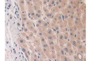IHC-P analysis of Human Liver cancer Tissue, with DAB staining. (PLA2G10 抗体  (AA 32-165))