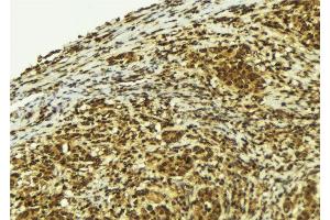 ABIN6279170 at 1/100 staining Human breast cancer tissue by IHC-P. (PIF1 抗体  (Internal Region))