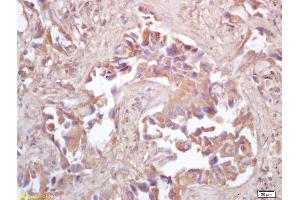 Formalin-fixed and paraffin embedded human lung carcinoma labeled with Rabbit Anti HSP10/CPN10 Polyclonal Antibody, Unconjugated (ABIN721885) at 1:200 followed by conjugation to the secondary antibody and DAB staining