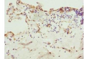 Immunohistochemistry of paraffin-embedded human breast cancer using ABIN7176368 at dilution of 1:100