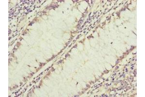 Immunohistochemistry of paraffin-embedded human colon cancer using ABIN7154562 at dilution of 1:100 (GRPEL1 抗体  (AA 1-217))