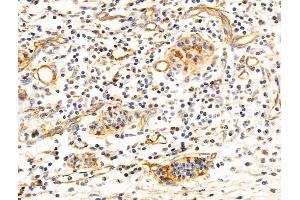 ABIN6260575 and ABIN6268769 at 1/100 staining Human pancreatic cancer by IHC-P. (CD147 抗体  (C-Term))