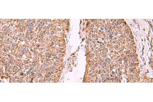 Immunohistochemistry of paraffin-embedded Human esophagus cancer tissue using PER3 Polyclonal Antibody at dilution of 1:55(x200) (PER3 抗体)
