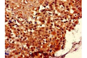 Immunohistochemistry of paraffin-embedded human breast cancer using ABIN7149126 at dilution of 1:100 (UBXN11 抗体  (AA 38-146))